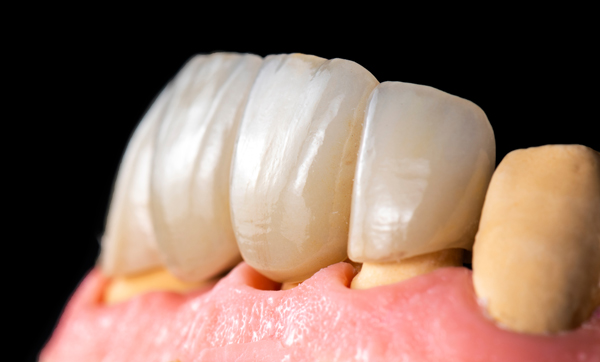 A Step By Step Guide To No Prep Dental Veneers