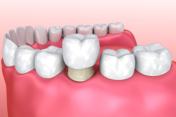 How A General Dentist Uses Crowns To Repair Teeth